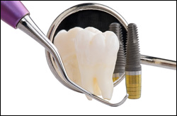 dental implants in Owings Mills MD