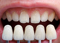 Veneers | Dentist In Owings Mills, MD |  Mendelson Family Dentistry